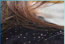 how to protect hair from dandruff in winter