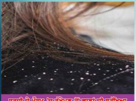 how to protect hair from dandruff in winter