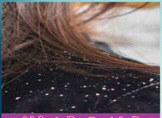 how to protect hair from dandruff in winter