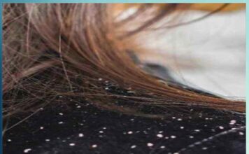 how to protect hair from dandruff in winter