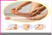 Diabetes Foot: ਸ਼ੂਗਰ ਕਰੋ ਬਚਾਅ, ਤਾਂ ਕਿ ਨਾ ਹੋਣ ਪੈਰਾਂ ਨਾਲ ਜੁੜੀਆਂ ਸਮੱਸਿਆਵਾਂ Diabetes Foot