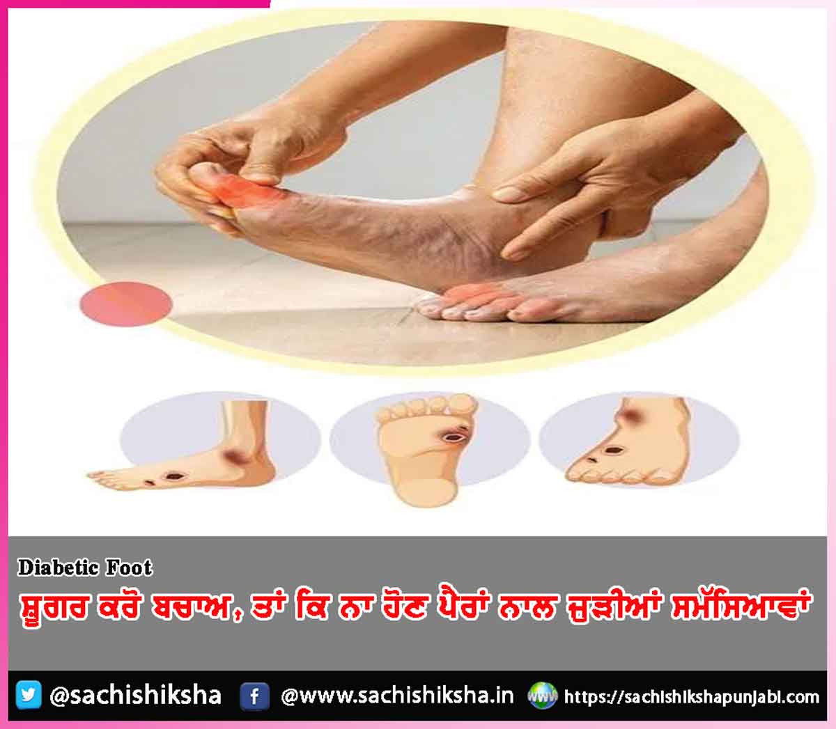 Diabetes Foot Diabetes Foot